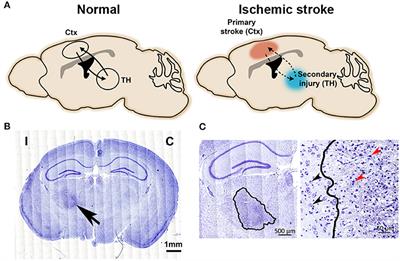 Inflammatory Responses in the Secondary Thalamic Injury After Cortical Ischemic Stroke